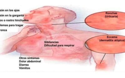 Pulpo: Causas y prevención de alergias en personas